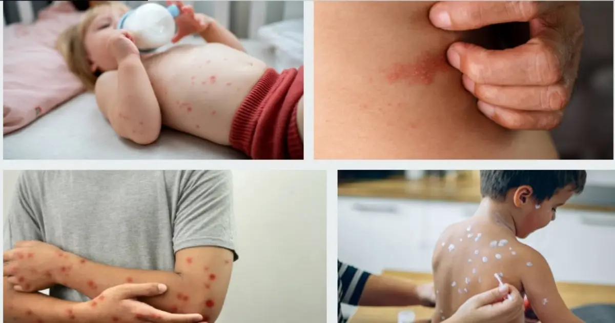 Chickenpox Symptoms Causes Treatment and Prevention