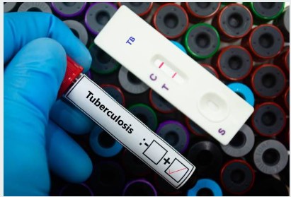 What is Tuberculosis? A Complete Guide to Causes, Symptoms, Diagnosis, Treatment & Prevention 3 TB Vaccine -BCG