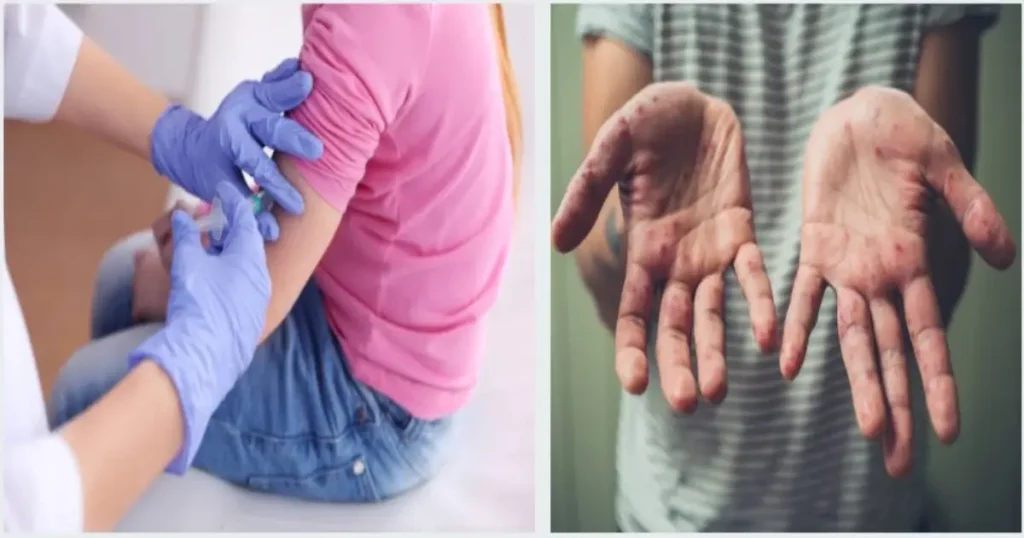 Everything You Need to Know About Chickenpox: Symptoms, Causes, Treatment, and Prevention 2 Treatment for Chickenpox