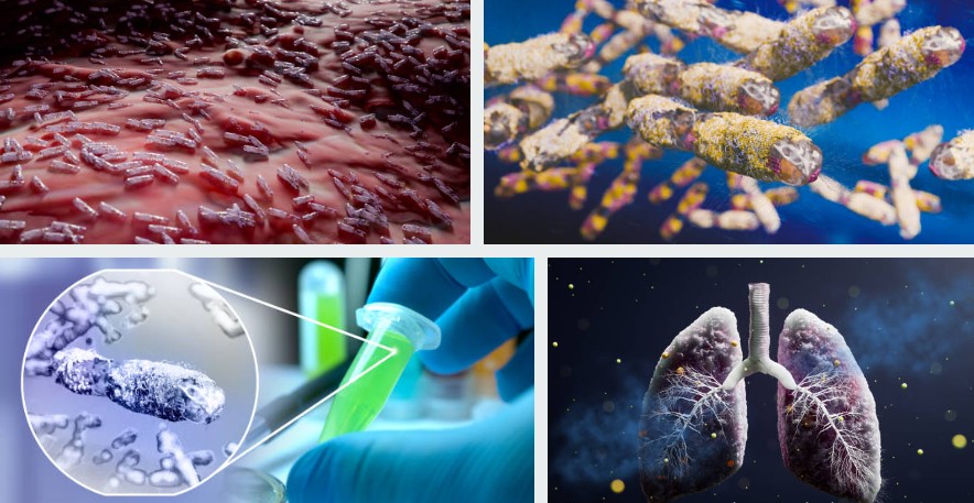 What is Tuberculosis ?