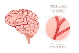 Stroke Stroke