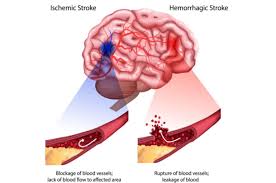 Stroke Stroke