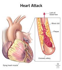 Heart Attack