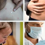 Measles Disease